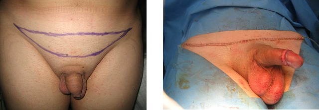 vasovaso-lipectomia-pre-post-cirugia